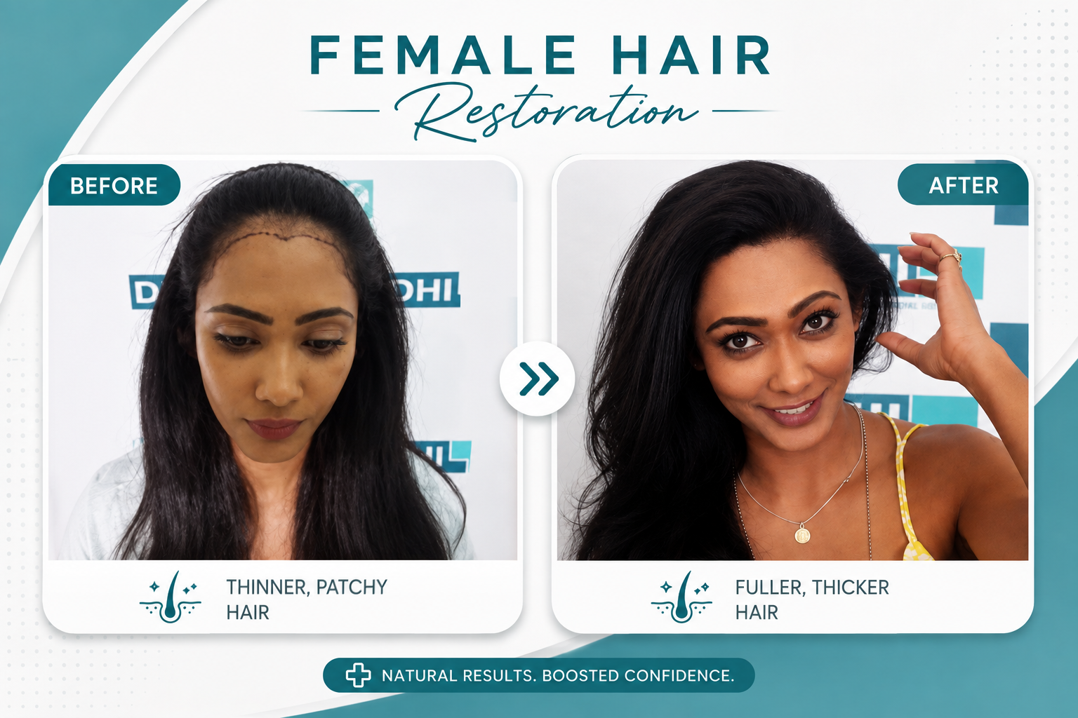Before and After DHI Hair Transplant Colombo patient