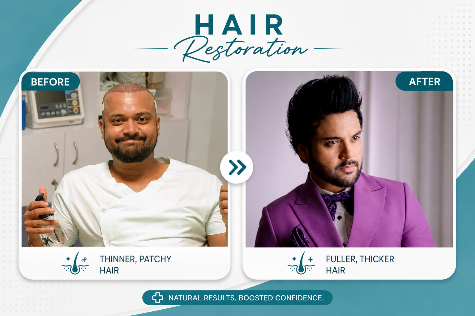 Before and After DHI Hair Transplant Colombo patient