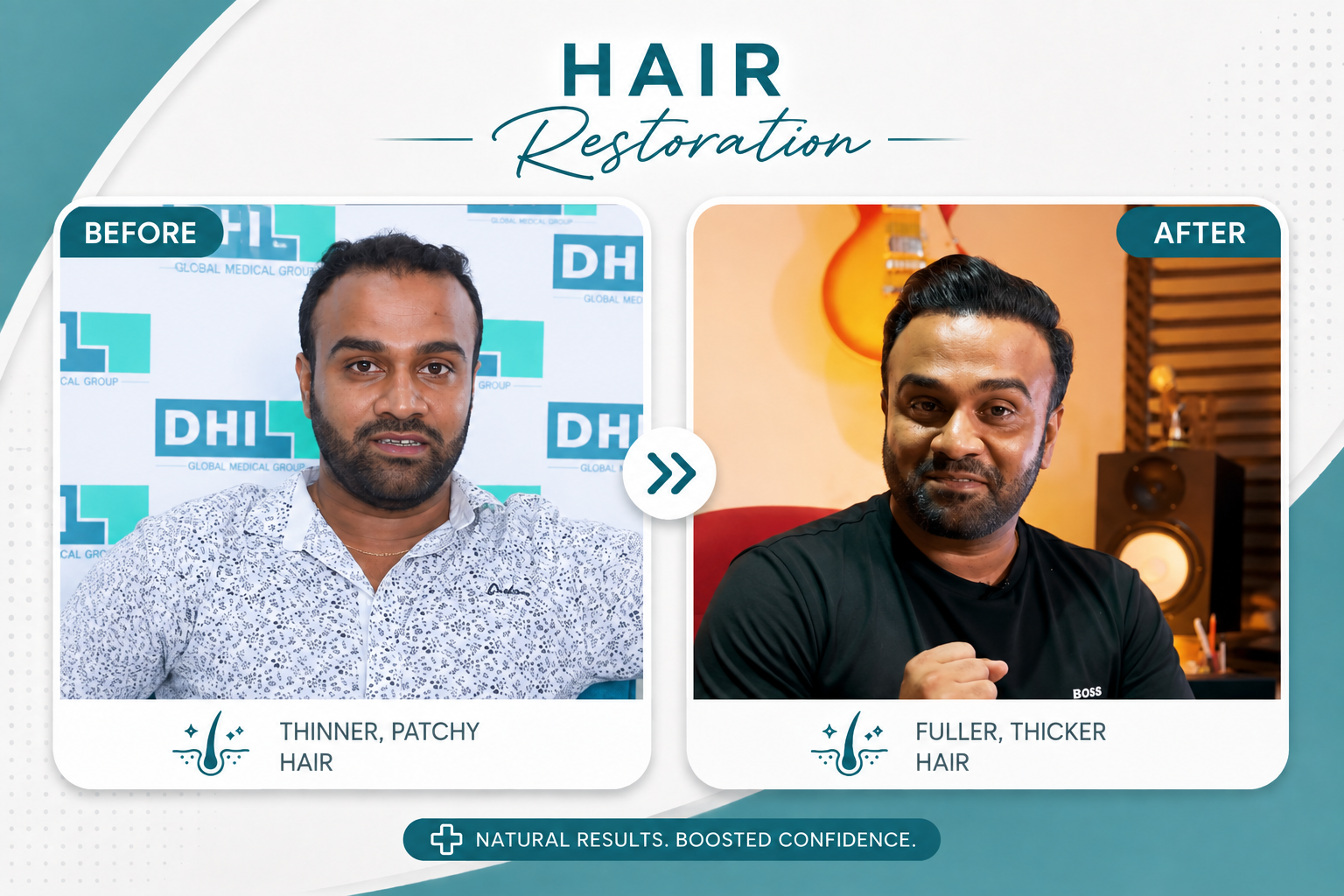 Before and After DHI Hair Transplant Colombo patient