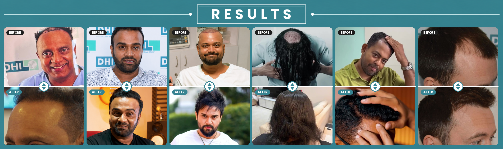 Hair loss treatment Sri Lanka