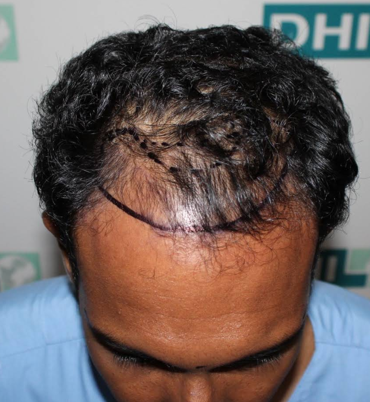 Hashan Chamara DHI hair transplant